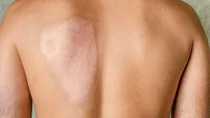 can burn scars be completely removed 