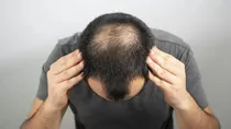 male pattern hair loss or androgenetic alopecia causes and treatment