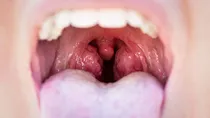 tonsil stone causes symptoms and treatment