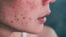 why you should not apply lemon juice on face to treat acne