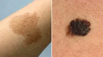 why birthmarks are formed and how to remove it