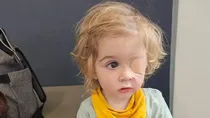 Cold Sore Infection Toddler Eye