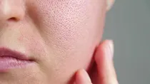 open pores causes and how to treatment it at home 