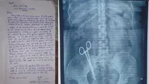 Scissor Which Left 17 Years Ago In Woman Stomach Was Recovered, Complaint Given By Husband