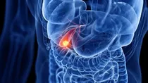 gallbladder cancer connection with gallstones research