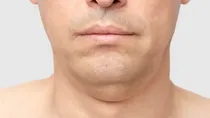 how to get rid of your double chin naturally