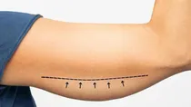 how to tighten loose skin after rapid weight Loss