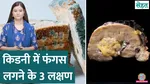 know everything about kidney fungal infection sehat 