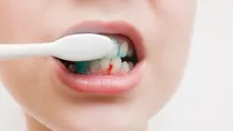 bleeding gums while brushing teeth causes and prevention