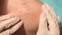 prickly heat causes prevention and treatment in summer