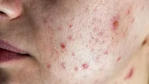 how to get rid of acne and pimples in monsoon season