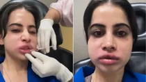 urfi javed got her lip fillers dissolved what does it mean