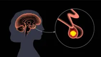 how serious is a pituitary tumor its causes symptoms treatment and prevention