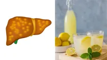 can drinking lemon water daily cure fatty liver