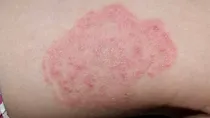 fungal infection in monsoon causes symptoms prevention and treatment 