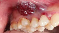 oral cancer causes symptoms prevention and treatment 