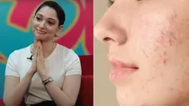 applying morning saliva to pimples is tamannaah Bhatia's pimple hack does it work