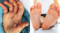 hand foot and mouth disease cases are rising in delhi hfmd causes symptoms and treatment 