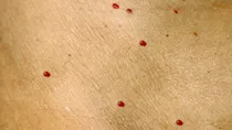 are cherry angiomas related to cancer 