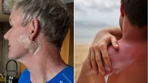 chef gordon ramsay undergoes surgery for skin cancer know everything about basal cell carcinoma