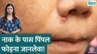  Doctor explains why you should not pop pimple near your nose 