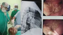 Odisha: 80 Year Old Man Swallowed Teeth Cleaning Chewing Stick