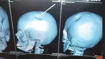 Andhra Class 6 girl suffers skull fracture after teacher hits her with lunch box bag