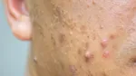 what is phone acne causes symptoms prevention & treatment 