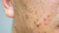 what is phone acne causes symptoms prevention & treatment 
