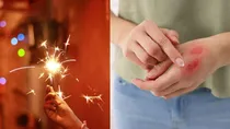 what to do if someone gets burned while bursting crackers 