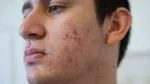 Doctor explains how to lighten acne scars with and without cosmetic treatments