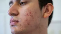 Doctor explains how to lighten acne scars with and without cosmetic treatments