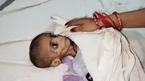 Madhya Pradesh Malnutrition