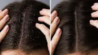 why do you get dandruff in the winter prevention treatment & best shampoo