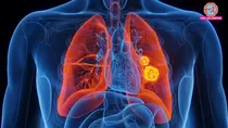 Lung Cancer cases to rise sharply by 2030 in india says latest study