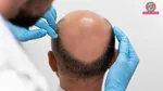 why hair transplants fail in some people