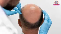why hair transplants fail in some people