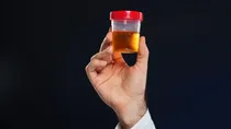 blood in urine causes symptoms treatment & prevention