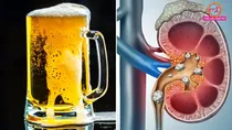 does beer really help pass kidney stones or can it make things worse