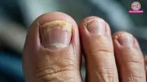 fungal nail infection causes symptoms home remedy & treatment 