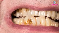 teeth stains causes prevention treatment & home remedies
