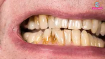 teeth stains causes prevention treatment & home remedies