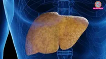 by 2050 1.8 Billion People May Have Fatty Liver know its symptoms test grades & treatment 