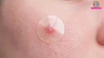common mistakes with pimple patches know right way to use it