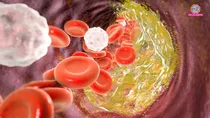 Bad Cholesterol
