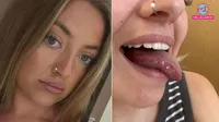 woman suffers from tongue ulcers for 2 years diagnosed with cancer
