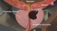 Prostatic Hyperplasia