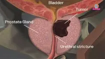 Prostatic Hyperplasia