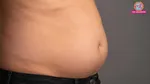 Fluid accumulation in the abdomen causes symptoms treatment & prevention