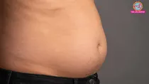 Fluid accumulation in the abdomen causes symptoms treatment & prevention